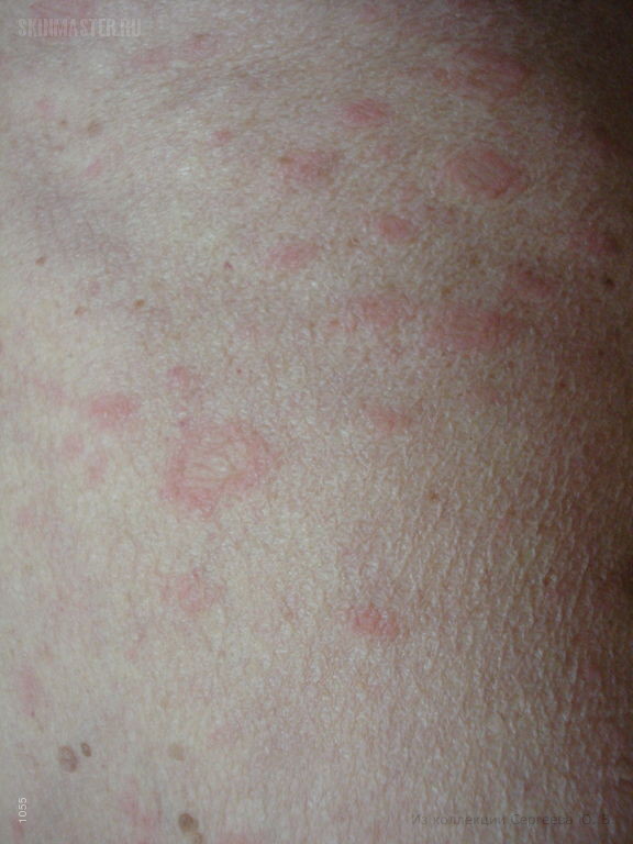 Токсикодермия фото