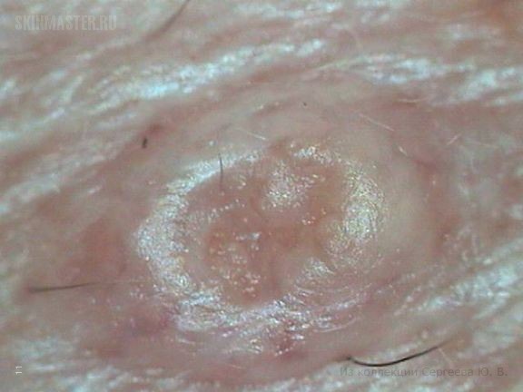 Сенильная гиперплазия сальной железы на коже лба