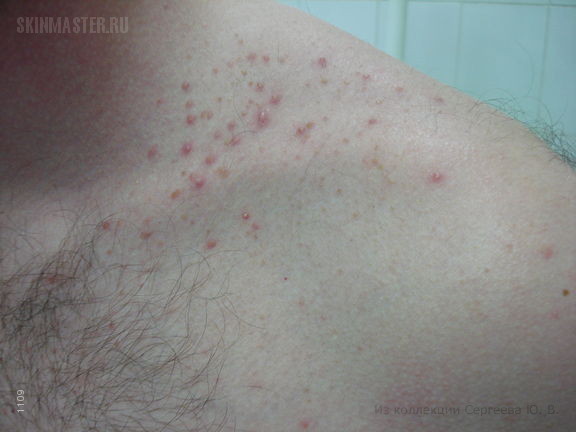   (acne aestivalis)