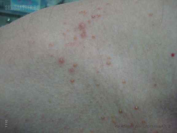   (acne aestivalis)