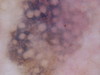 Базалиома и лентиго-малигна (меланома). №1172