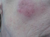 Лимфоплазия кожи. Клинические фото #1246