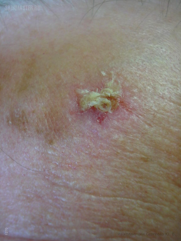 Плоскоклеточный рак кожи с ороговением
