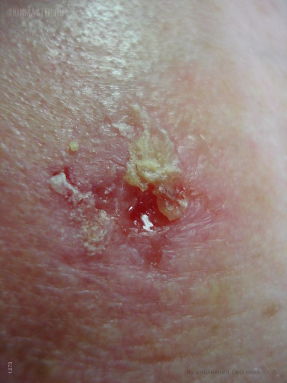 Плоскоклеточный рак кожи с ороговением