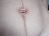 Дерматозы беременных: черная линия (linea nigra) и меланоцитарные невусы. №1304