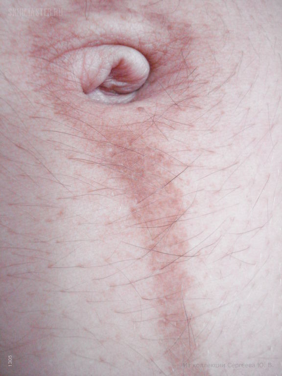 Дерматозы беременных: черная линия (linea nigra) и меланоцитарные невусы