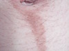 Дерматозы беременных: черная линия (linea nigra) и меланоцитарные невусы. №1305