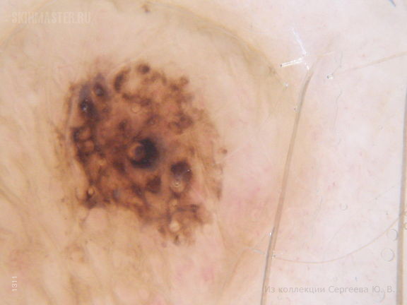 Дерматозы беременных: черная линия (linea nigra) и меланоцитарные невусы