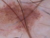 Дерматозы беременных: черная линия (linea nigra) и меланоцитарные невусы. №1314