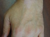 Гипопигментация кожи у больного псориазом, индуцированная кортикостероидами. №1315