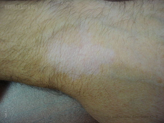 Гипопигментация кожи у больного псориазом, индуцированная кортикостероидами