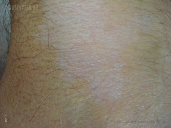 Гипопигментация кожи у больного псориазом, индуцированная кортикостероидами