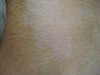 Гипопигментация кожи у больного псориазом, индуцированная кортикостероидами. №1318