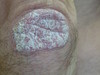Гипопигментация кожи у больного псориазом, индуцированная кортикостероидами. №1319