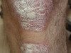 Гипопигментация кожи у больного псориазом, индуцированная кортикостероидами. №1320