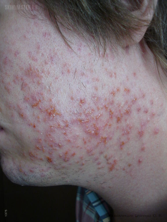     (folliculitis eczematoza barbae)