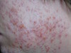     (folliculitis eczematoza barbae). 1375