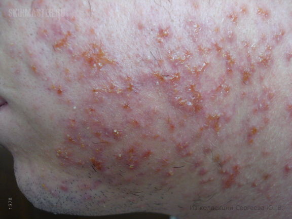     (folliculitis eczematoza barbae)