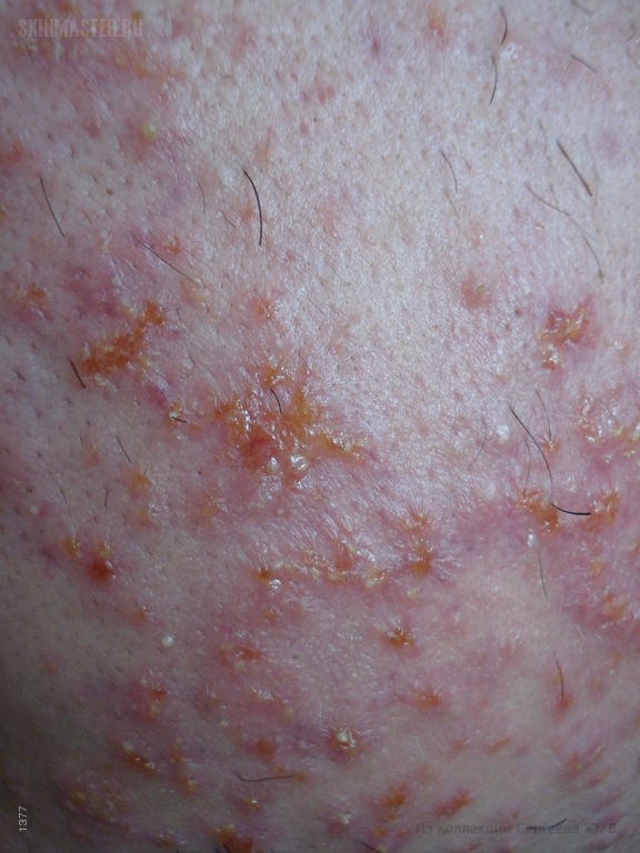     (folliculitis eczematoza barbae)