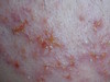     (folliculitis eczematoza barbae). 1377