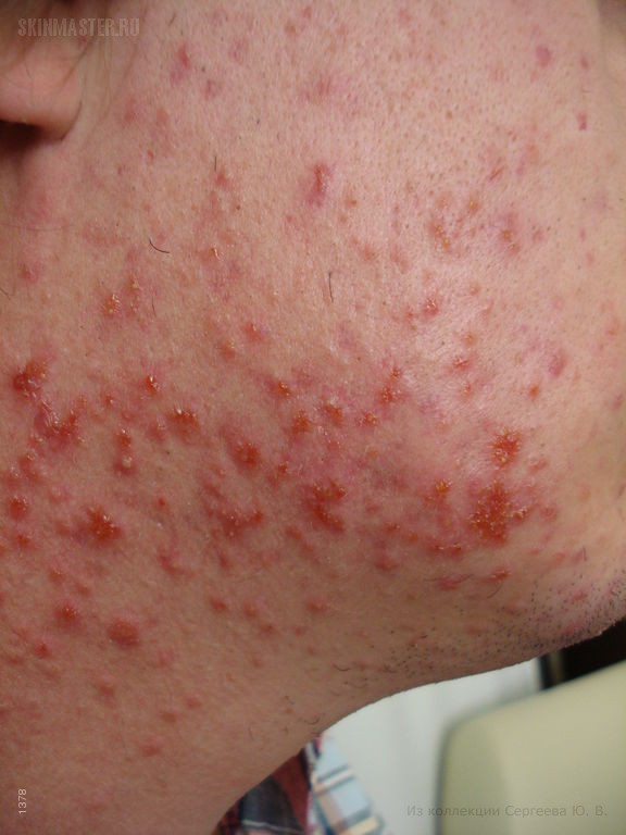     (folliculitis eczematoza barbae)