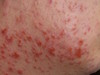     (folliculitis eczematoza barbae). 1378