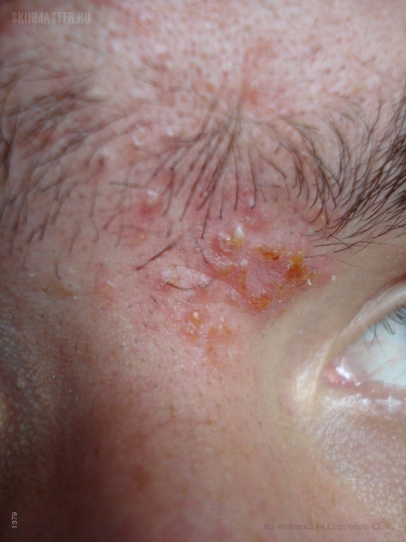     (folliculitis eczematoza barbae)