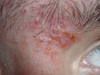     (folliculitis eczematoza barbae). 1379