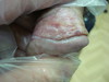 Склеродермия бляшечная. Клинические фото #1494