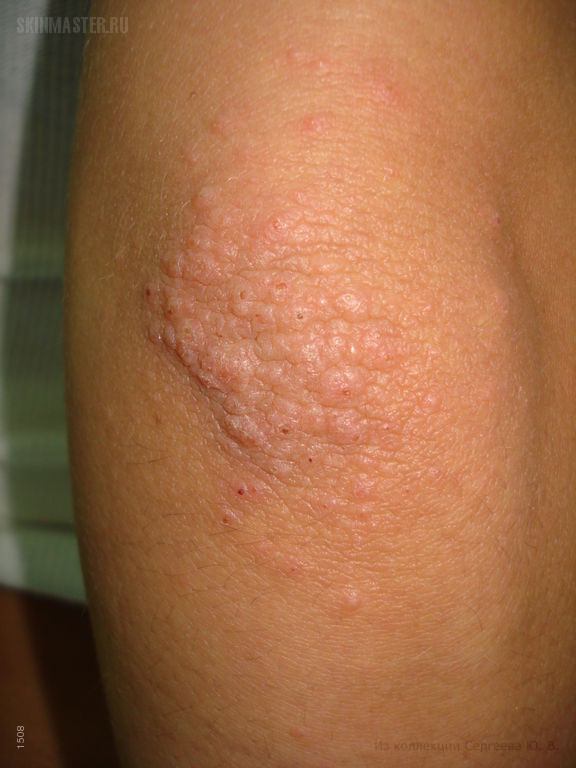 Аквагенная болезнь: шистосомный дерматит