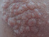 Аквагенная болезнь: шистосомный дерматит. №1512