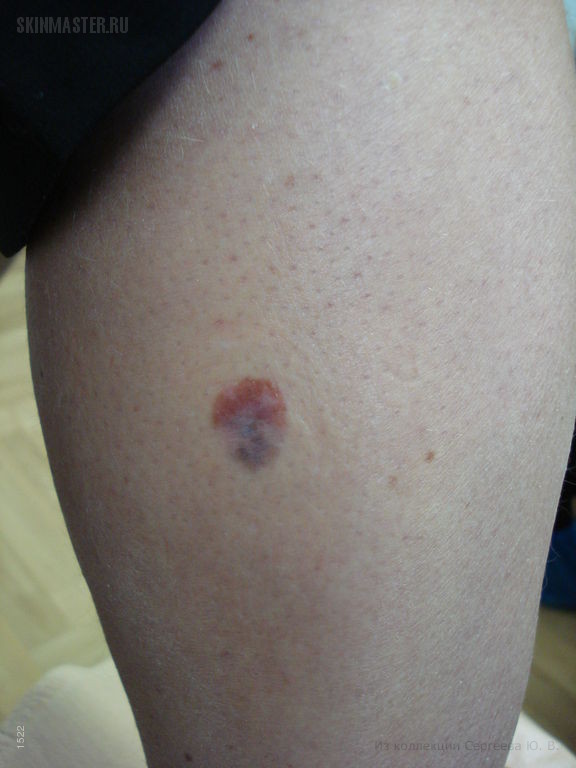 Беспигментная форма меланомы и внутридермальные невусы. Случай №487 ...