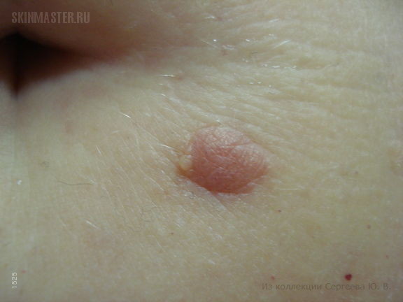 Беспигментная форма меланомы и внутридермальные невусы. Случай №487 из ...