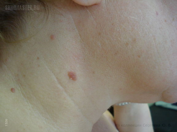 Беспигментная форма меланомы и внутридермальные невусы. Случай №487 из ...