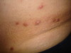 Лимфоплазия кожи. Клинические фото #1567