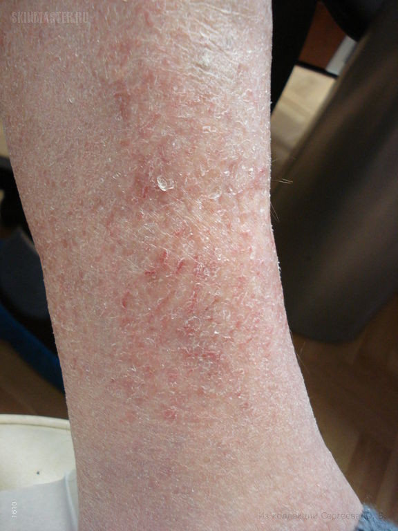  , eczema craquele