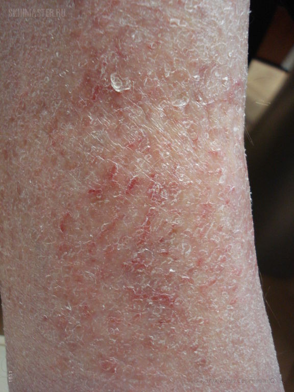  , eczema craquele