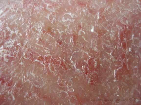  , eczema craquele