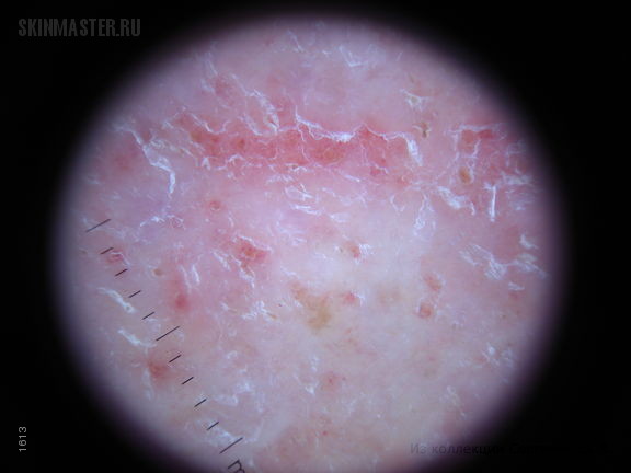 Астеатотическая экзема, eczema craquele