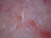 Астеатотическая экзема, eczema craquele. №1614