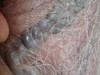 Варикозная болезнь: варикозное расширение вен кожи мошонки, голеней и «венозное озерцо» волосистой.... №1671