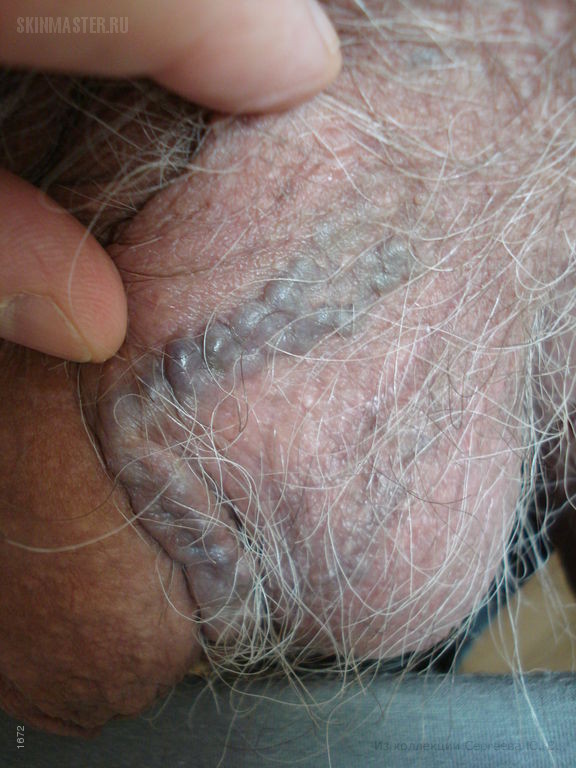 Варикозная болезнь: варикозное расширение вен кожи мошонки, голеней и «венозное озерцо» волосистой части головы
