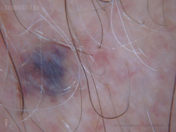 Варикозная болезнь: варикозное расширение вен кожи мошонки, голеней и «венозное озерцо» волосистой части головы