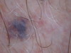 Варикозная болезнь: варикозное расширение вен кожи мошонки, голеней и «венозное озерцо» волосистой.... №1673