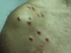 Лимфоплазия кожи. Клинические фото #18