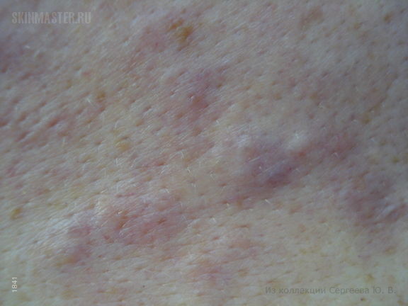 В-клеточная злокачественная лимфома кожи