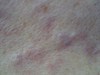 В-клеточная злокачественная лимфома кожи. №1841
