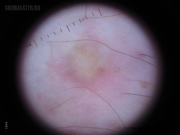 В-клеточная злокачественная лимфома кожи