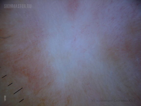 Ятрогенная рубцово-пигментная атрофия кожи