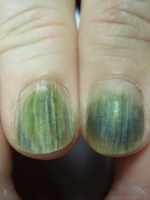 Синдром зеленых ногтей